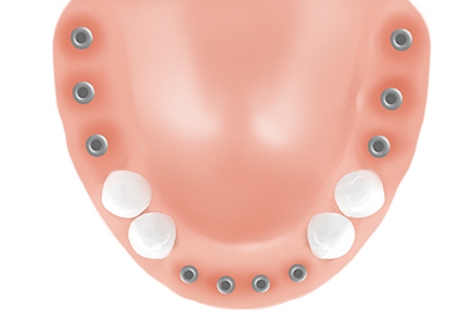 다수의 치아 임플란트 식립시 이러한 점을 주의해야 합니다.