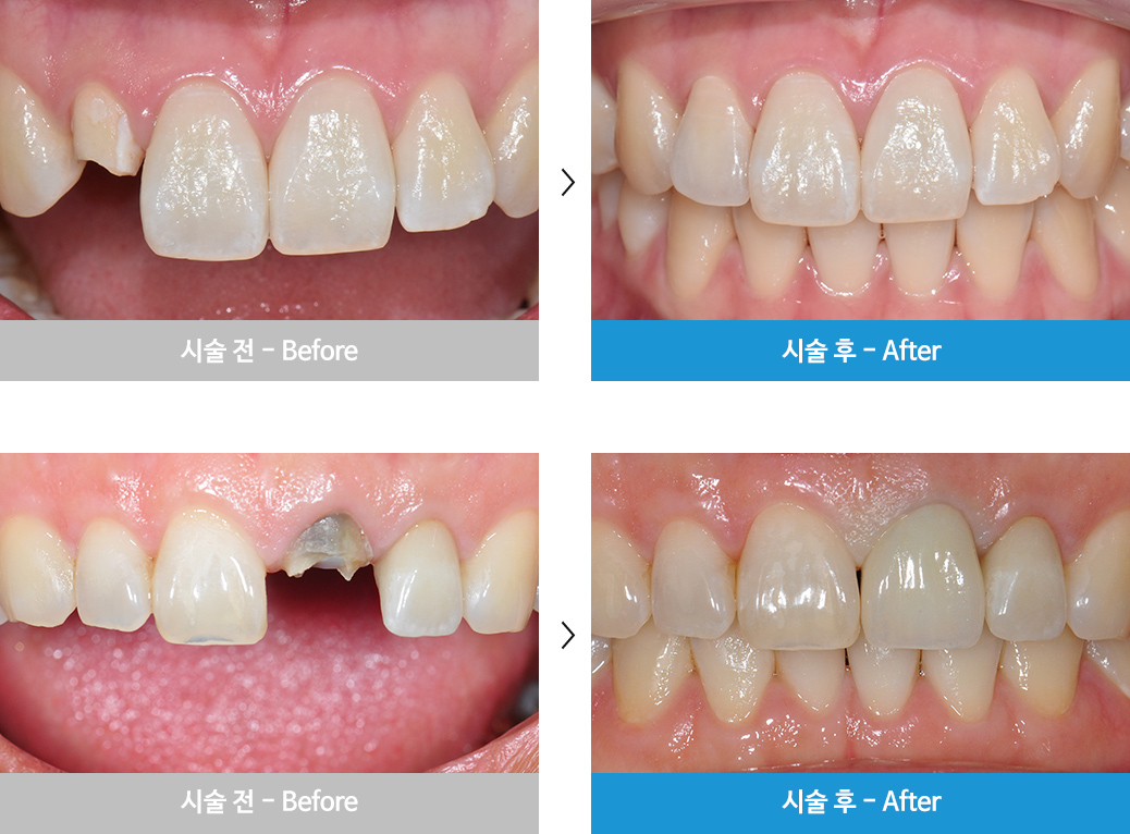 앞니 임플란트 시술 전후 사진